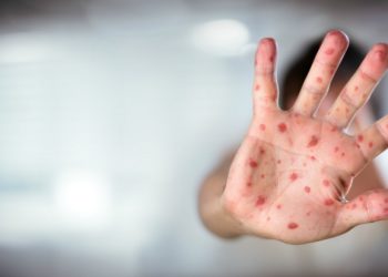 Are chicken pox parties a good idea?