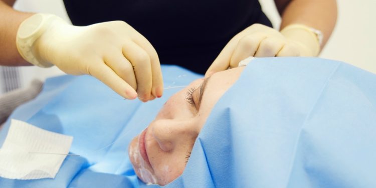 Silhouette Facelift Procedure