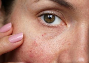 How to treat thread veins